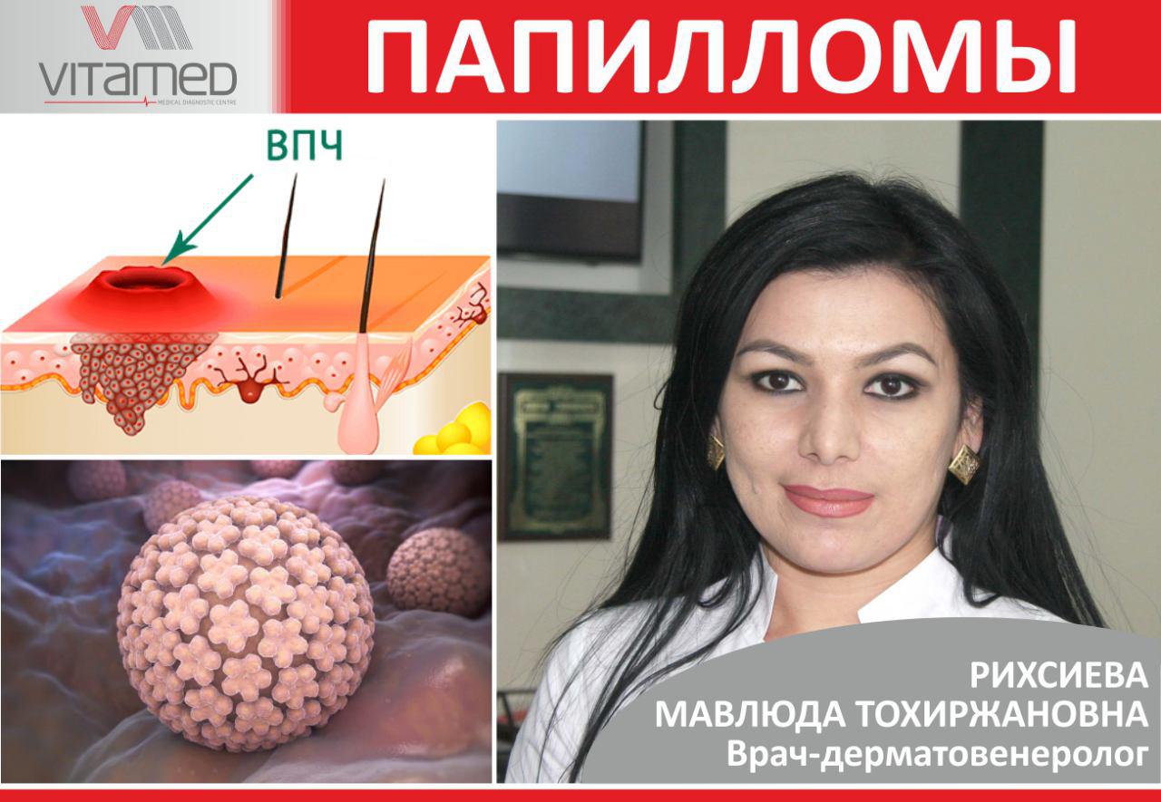 ПАПИЛЛОМЫ