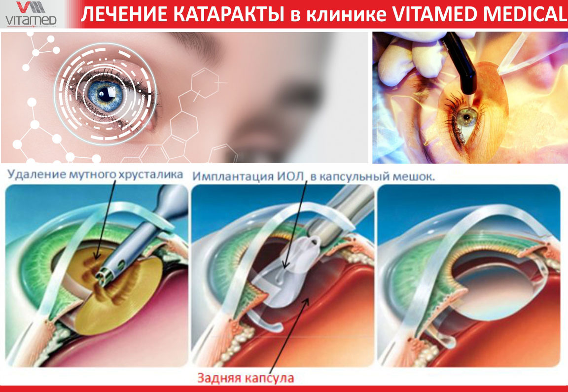 Лечение катаракты в клинике VITAMED MEDICAL