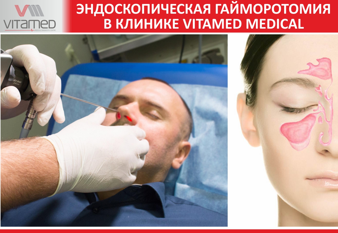 Эндоскопическая гайморотомия  в клинике  VITAMED MEDICAL.