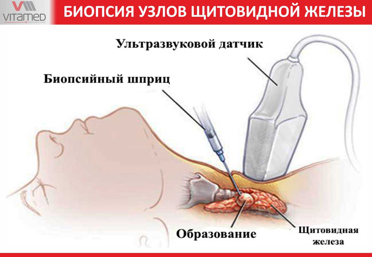 Qalqonsimon bez tugunlarining biopsiyasi